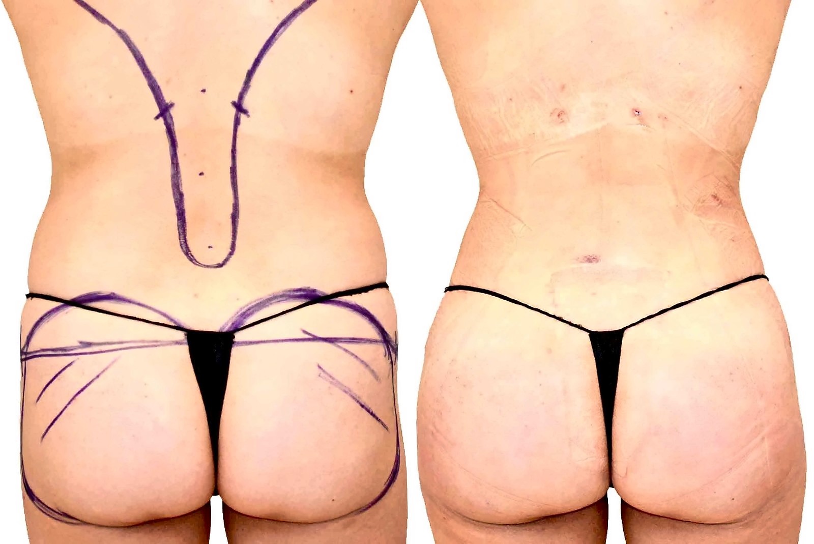 Before/After Fat Transfer, BBL before and after, actual patient of Dr. Long