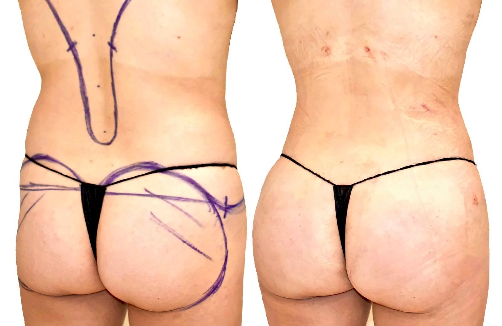 Before/After Fat Transfer, BBL before and after, actual patient of Dr. Long