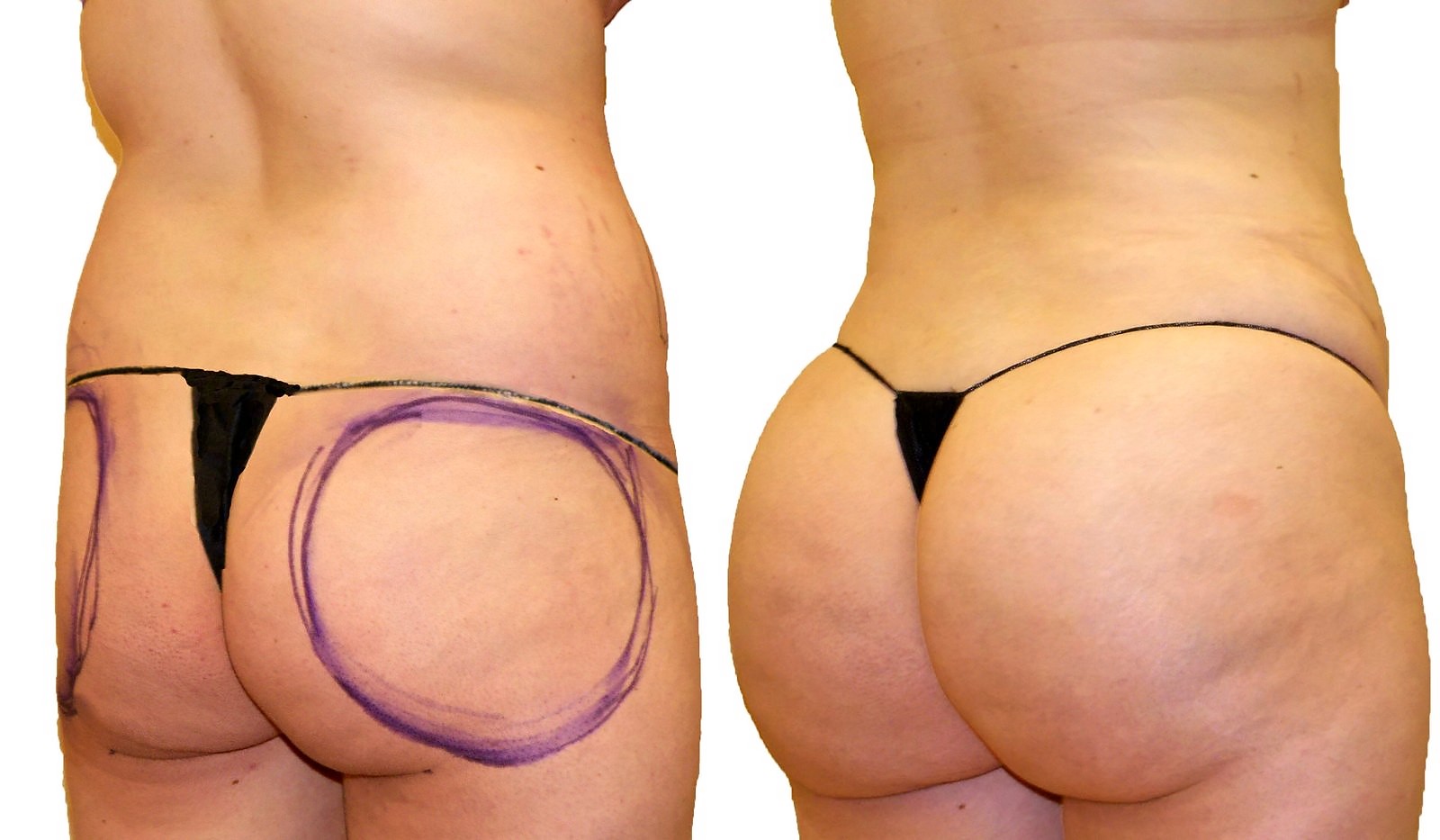 Before/After Fat Transfer, BBL before and after, actual patient of Dr. Long