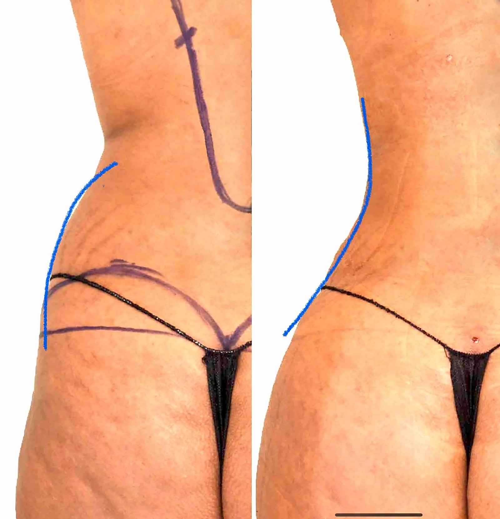 Before/After Fat Transfer, BBL before and after, actual patient of Dr. Long