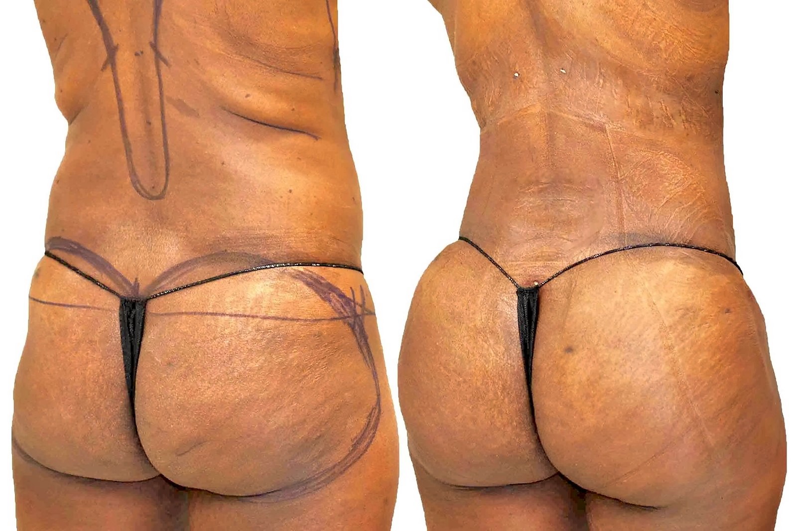Before/After Fat Transfer, BBL before and after, actual patient of Dr. Long