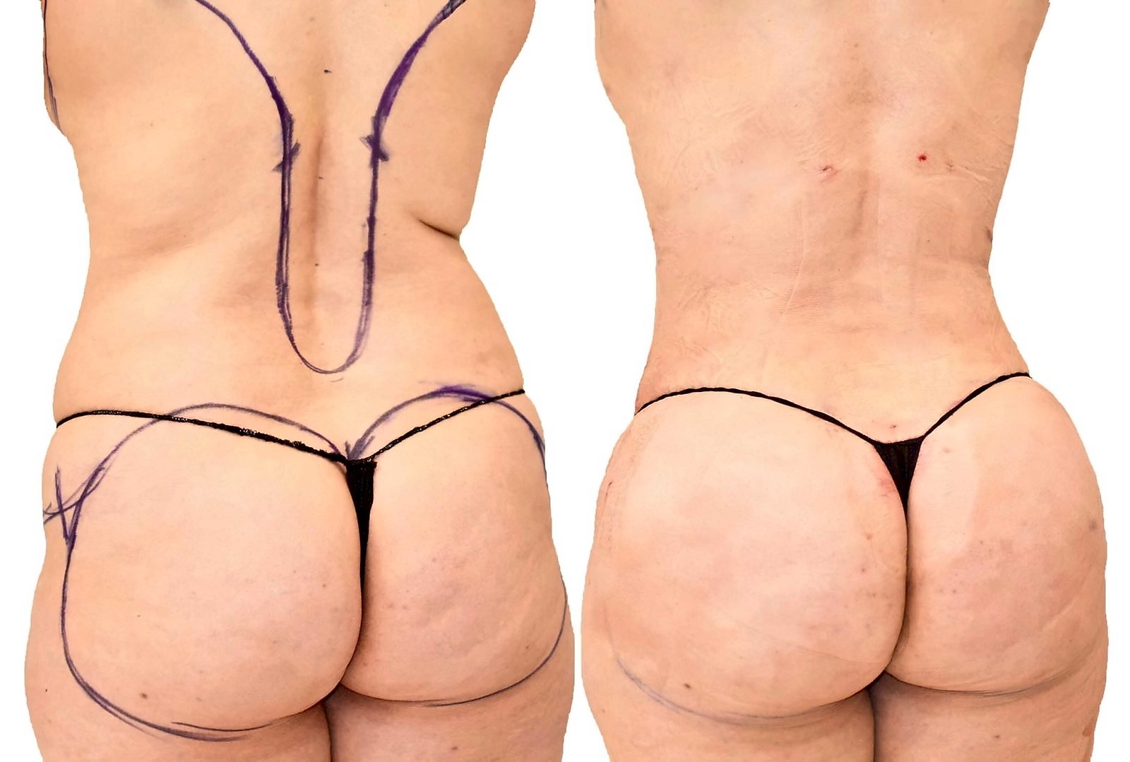 Before/After Fat Transfer, BBL before and after, actual patient of Dr. Long