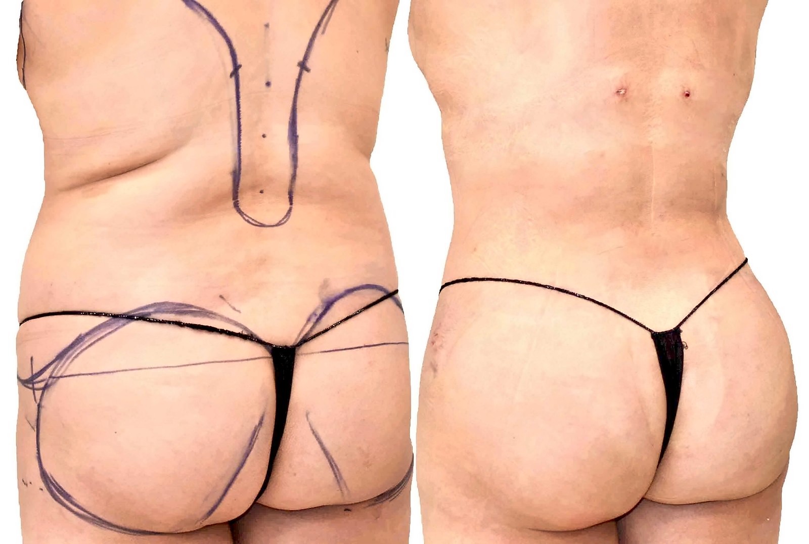 Before/After Fat Transfer, BBL before and after, actual patient of Dr. Long