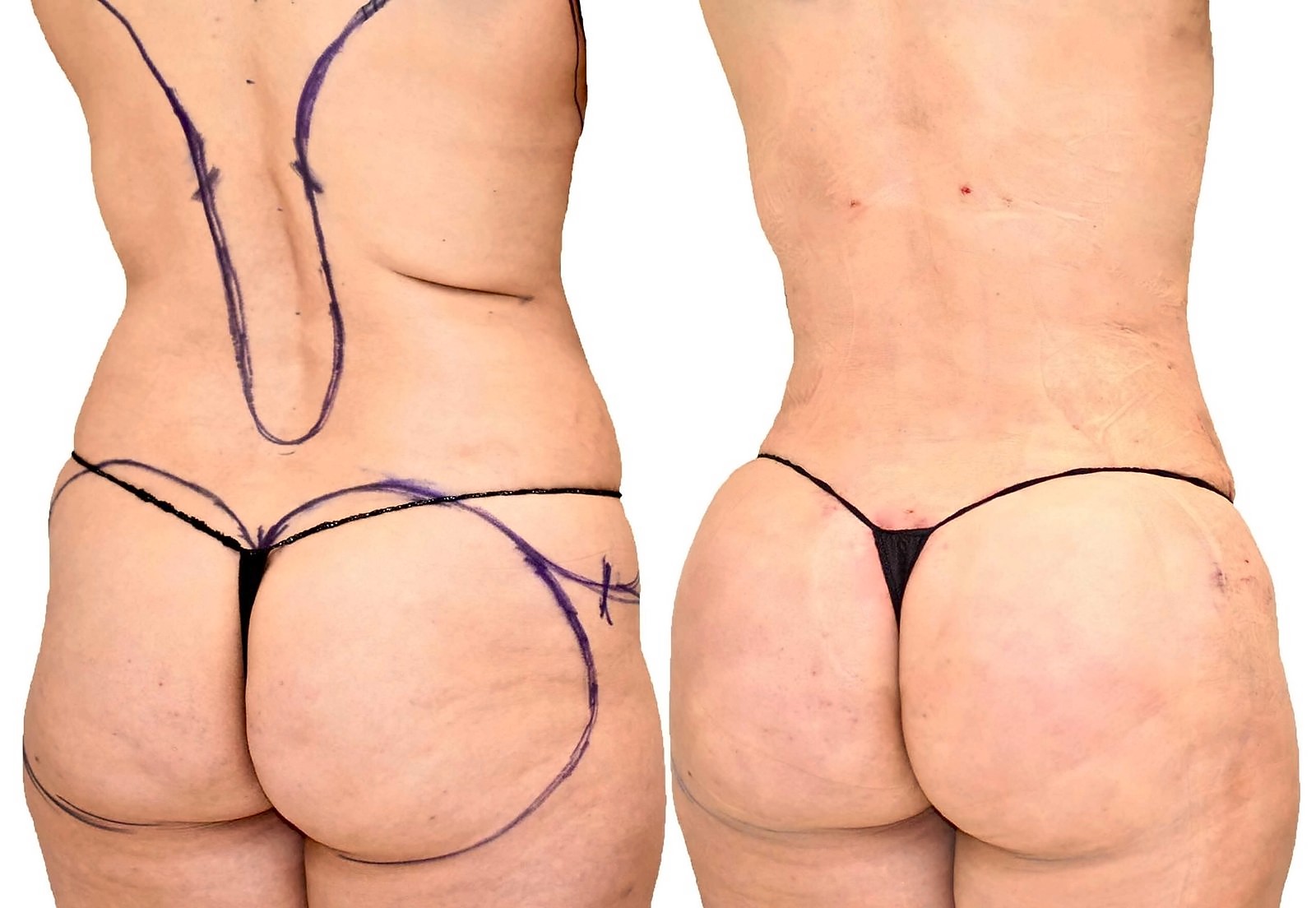Before/After Fat Transfer, BBL before and after, actual patient of Dr. Long