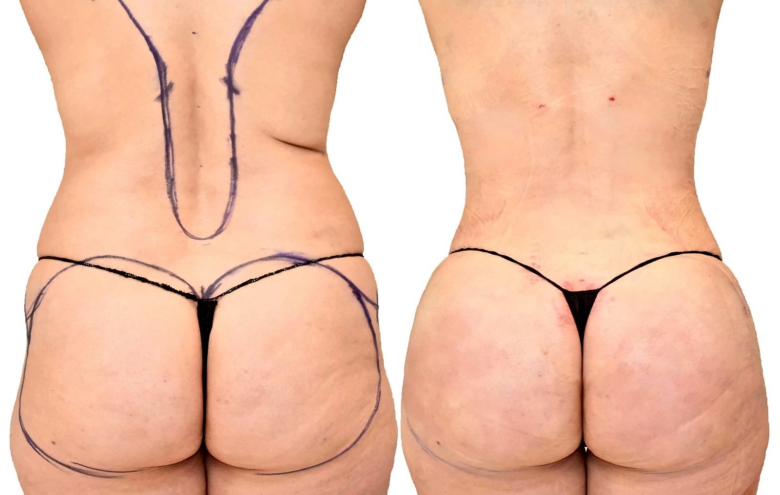 Before/After Fat Transfer, BBL before and after, actual patient of Dr. Long