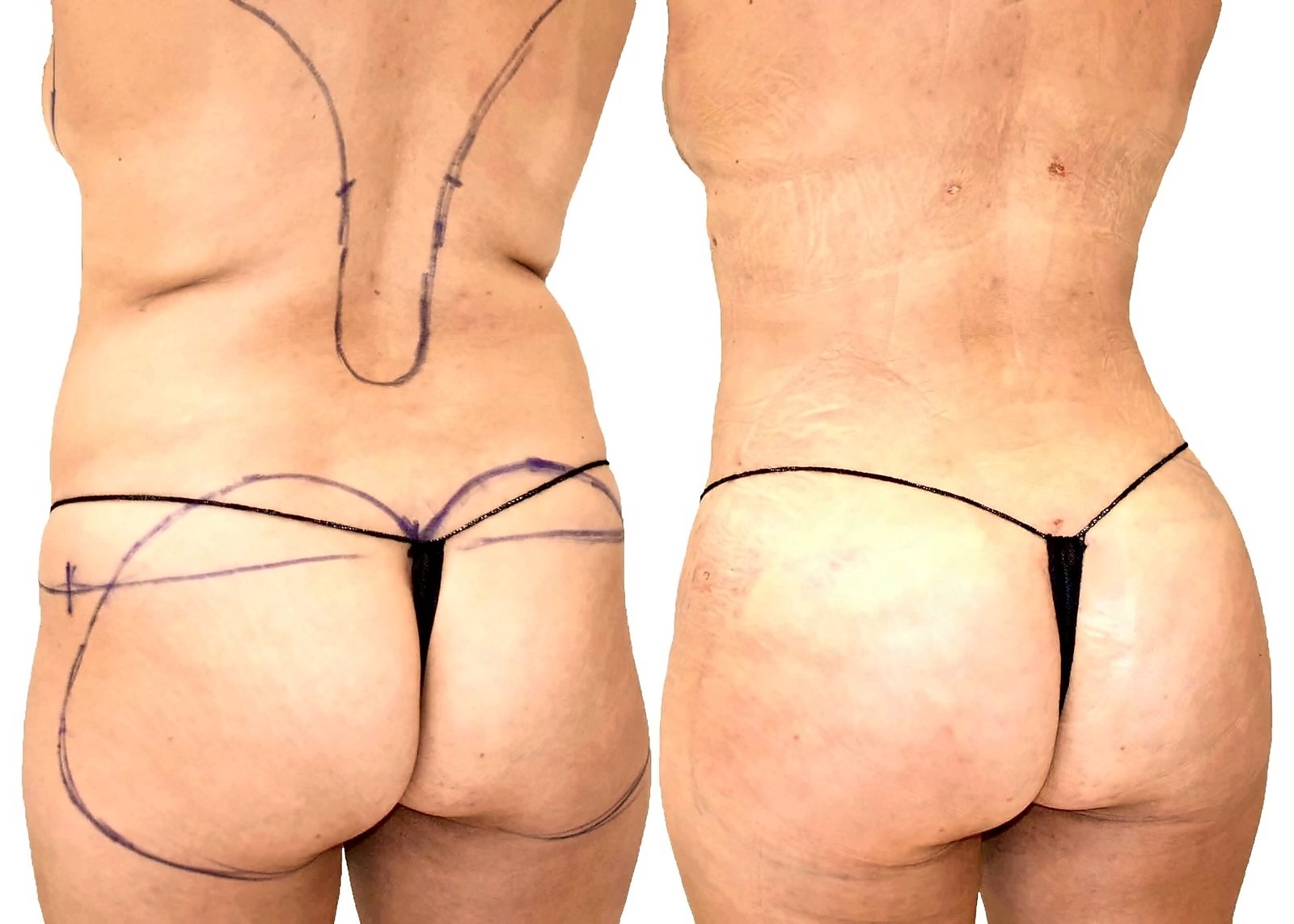 Before/After Fat Transfer, BBL before and after, actual patient of Dr. Long