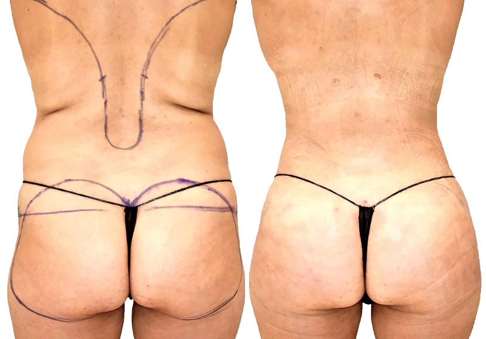 Before/After Fat Transfer, BBL before and after, actual patient of Dr. Long
