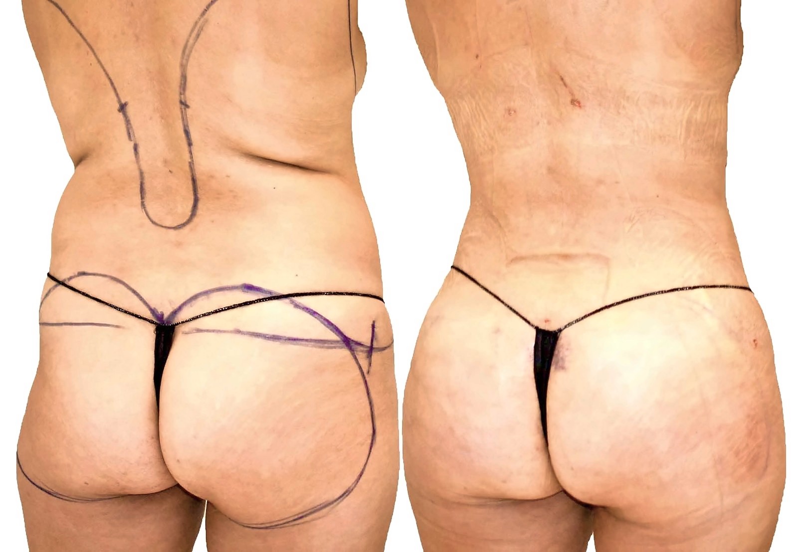 Before/After Fat Transfer, BBL before and after, actual patient of Dr. Long