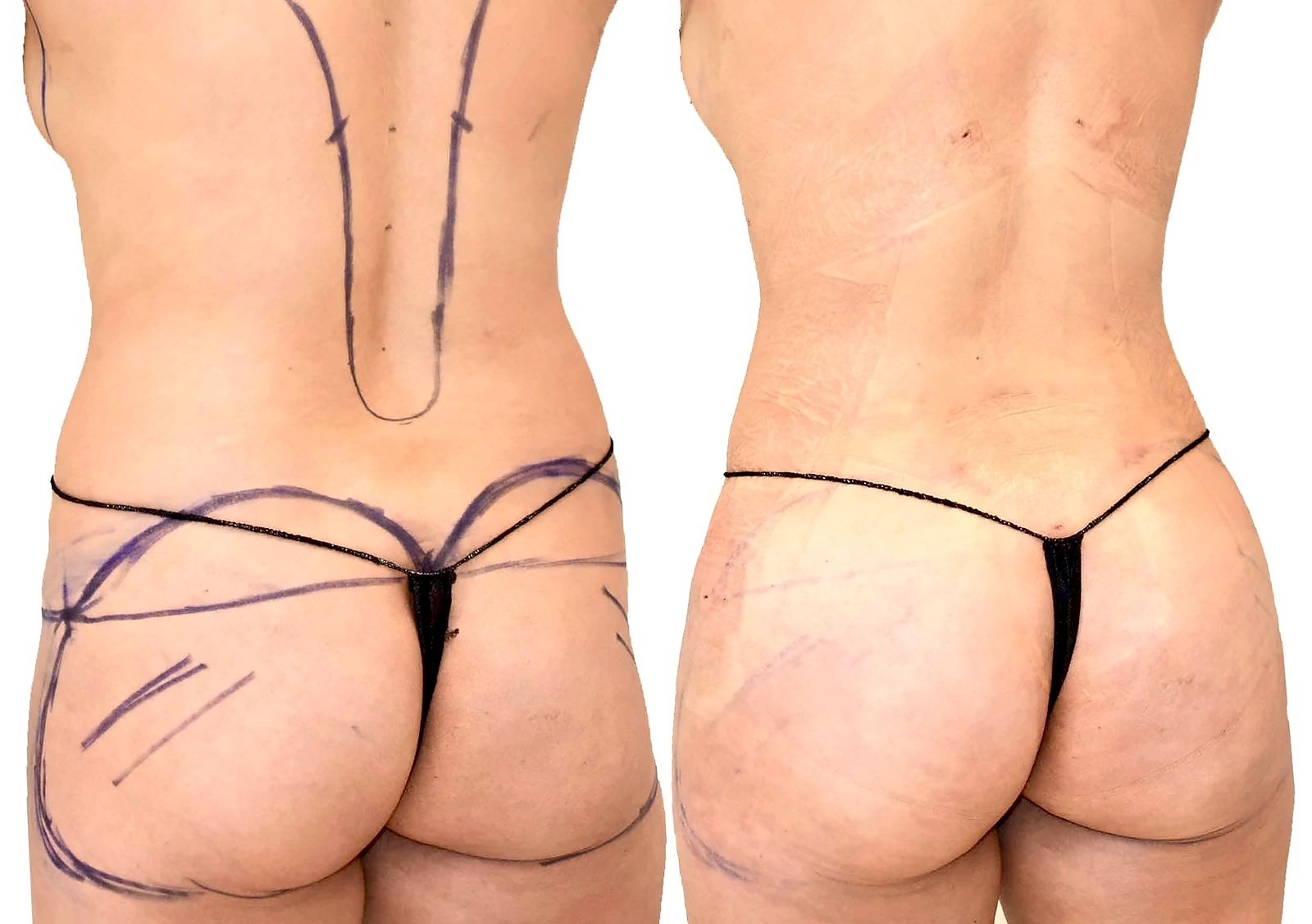 Before/After Fat Transfer, BBL before and after, actual patient of Dr. Long