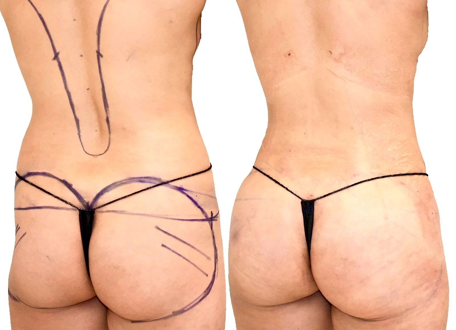 Before/After Fat Transfer, BBL before and after, actual patient of Dr. Long