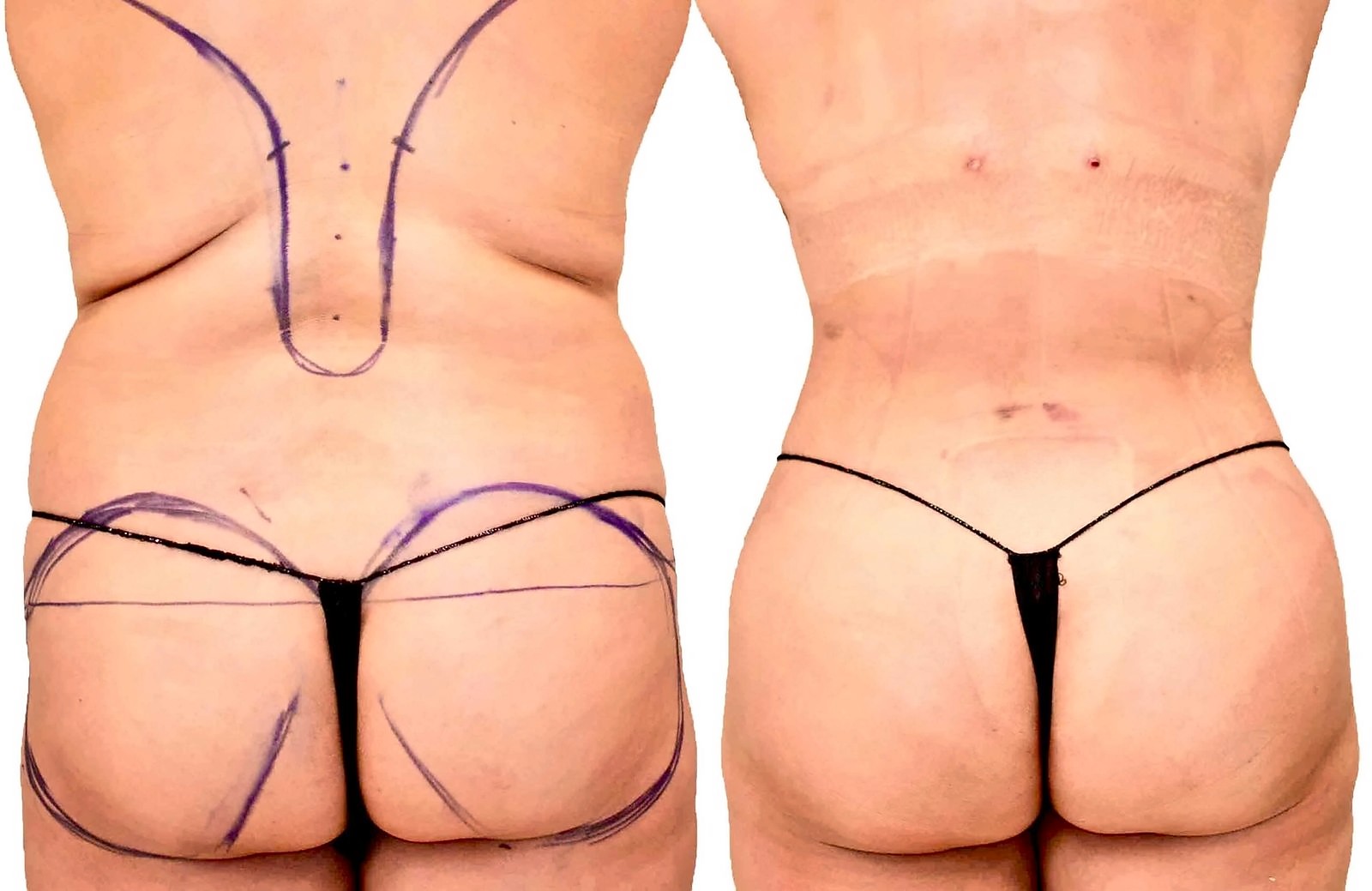 Before/After Fat Transfer, BBL before and after, actual patient of Dr. Long