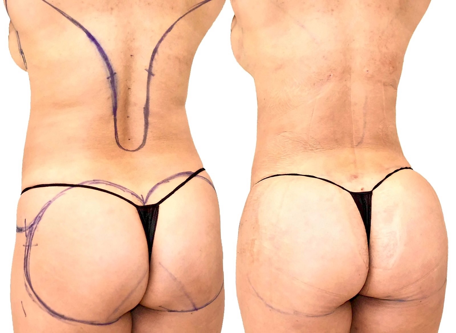 Before/After Fat Transfer, BBL before and after, actual patient of Dr. Long