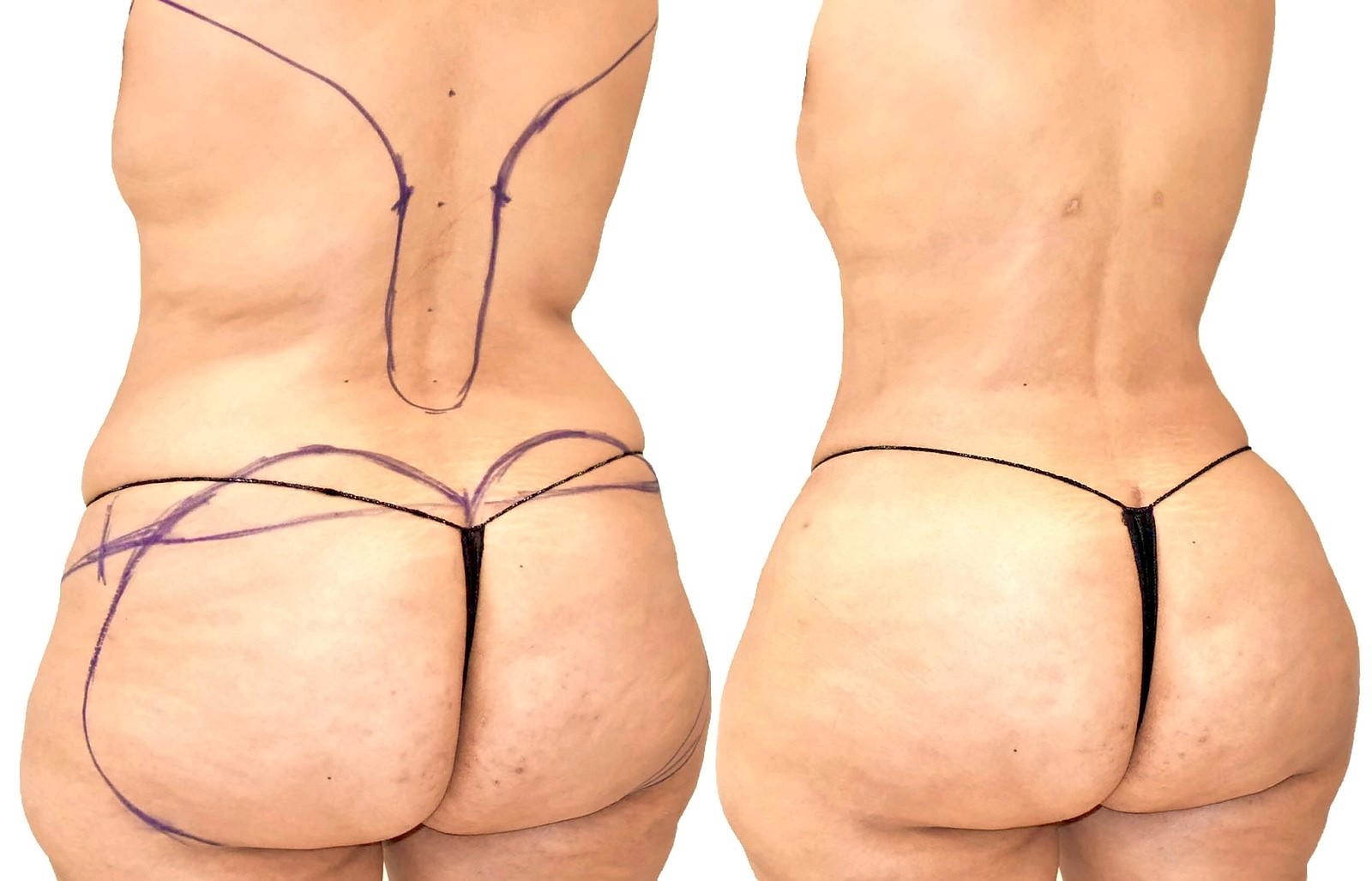 Before/After Fat Transfer, BBL before and after, actual patient of Dr. Long