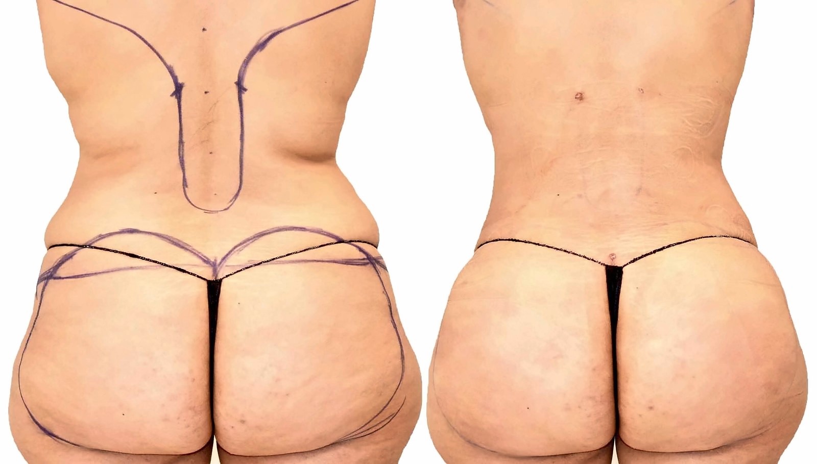 Before/After Fat Transfer, BBL before and after, actual patient of Dr. Long