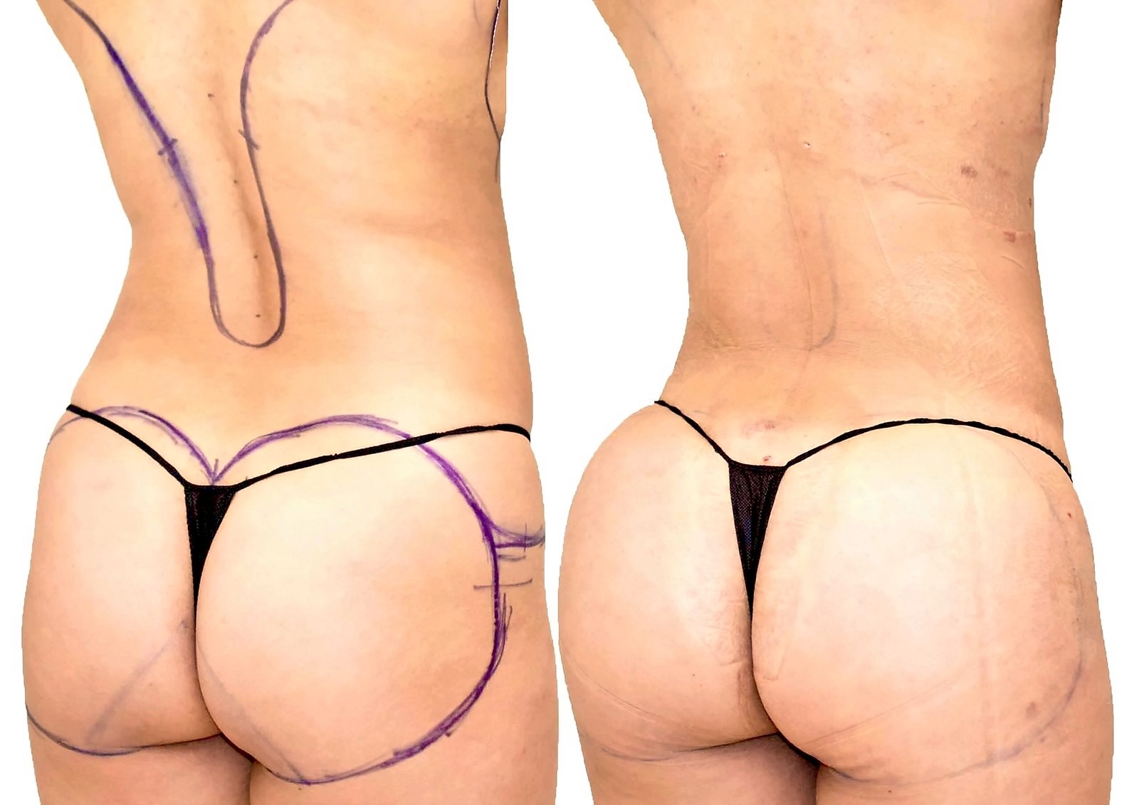 Before/After Fat Transfer, BBL before and after, actual patient of Dr. Long