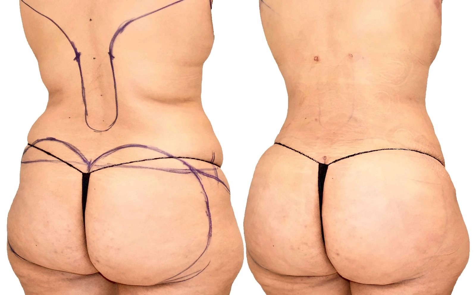 Before/After Fat Transfer, BBL before and after, actual patient of Dr. Long