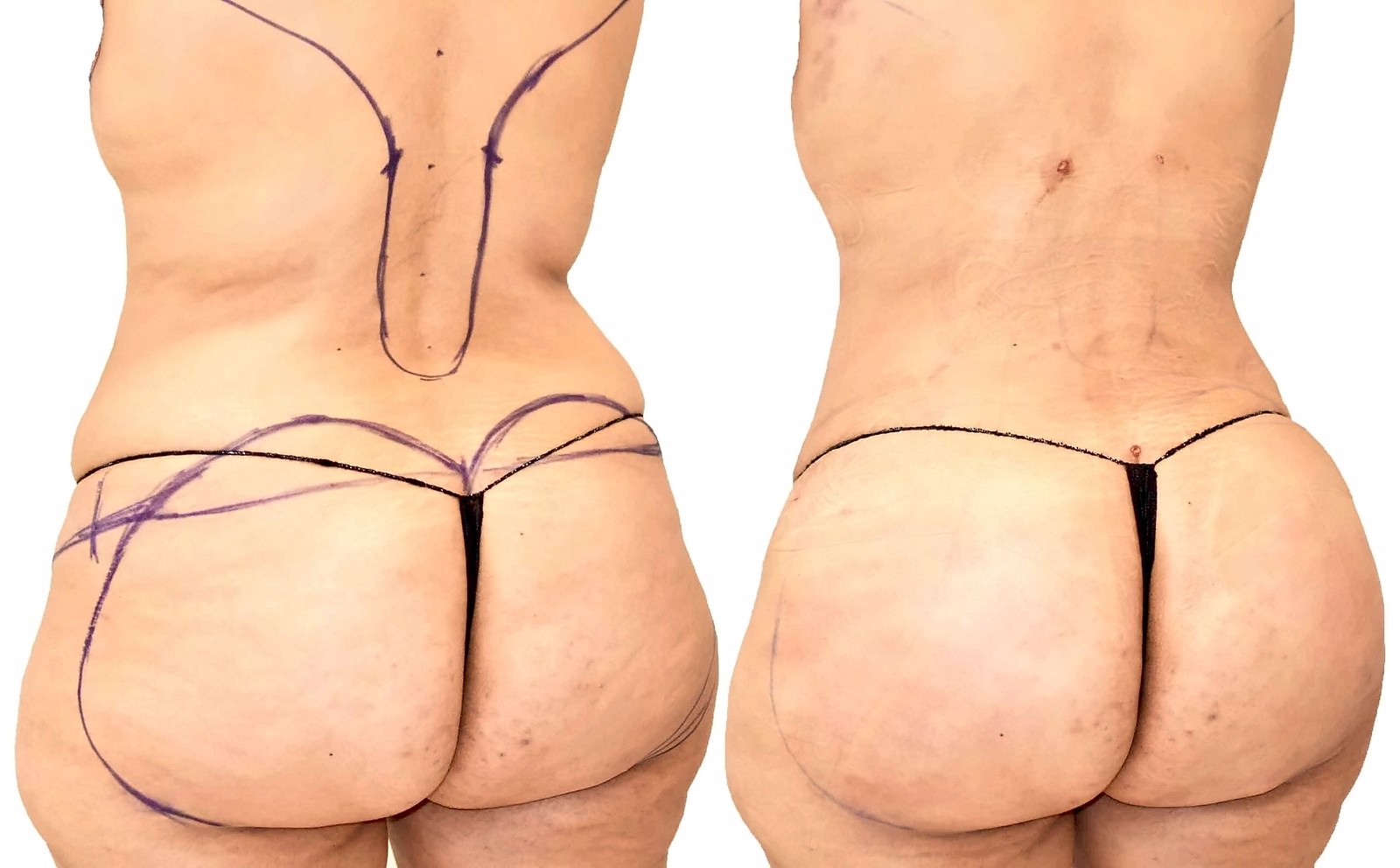 Before/After Fat Transfer, BBL before and after, actual patient of Dr. Long