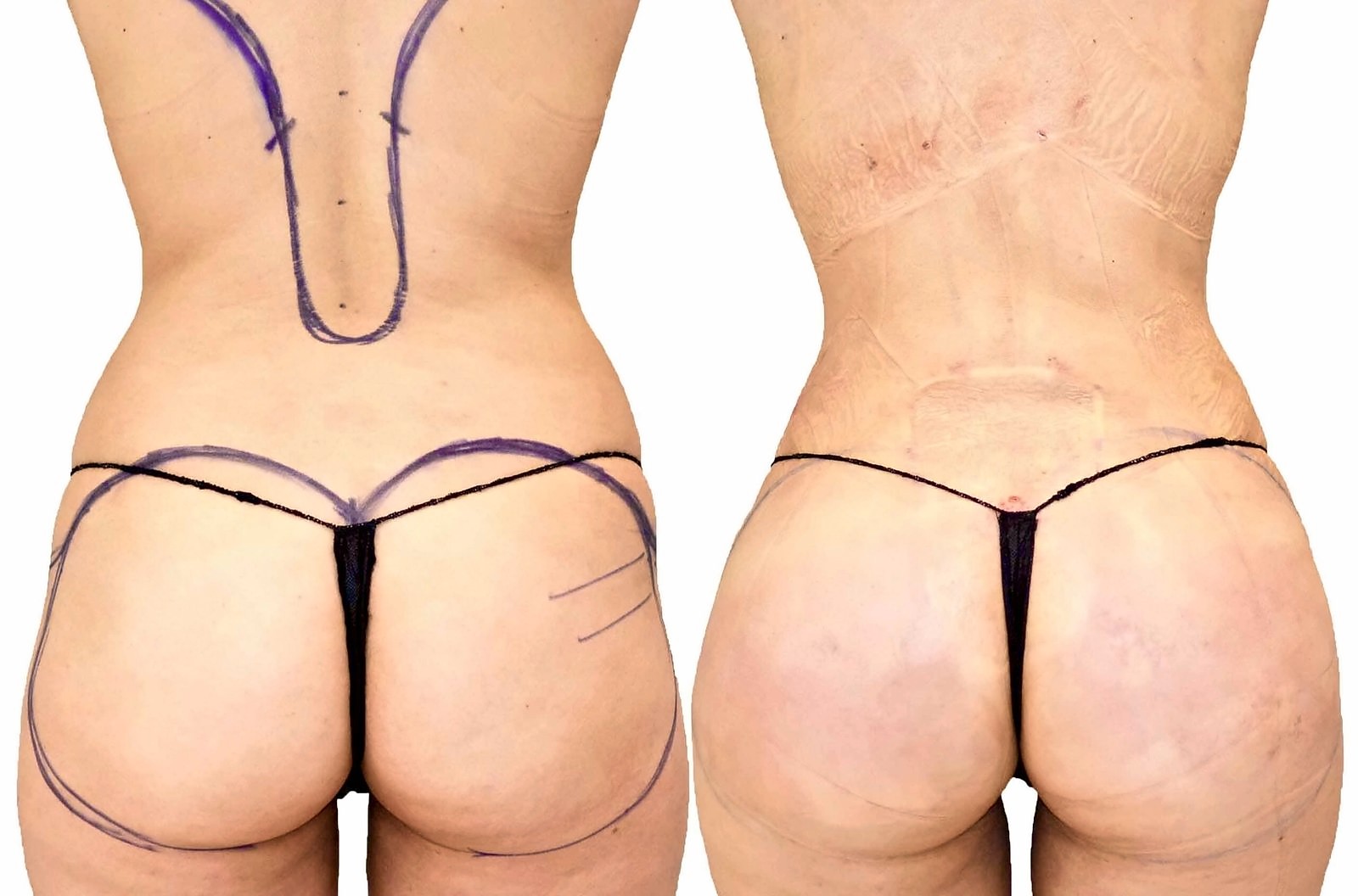 Before/After Fat Transfer, BBL before and after, actual patient of Dr. Long