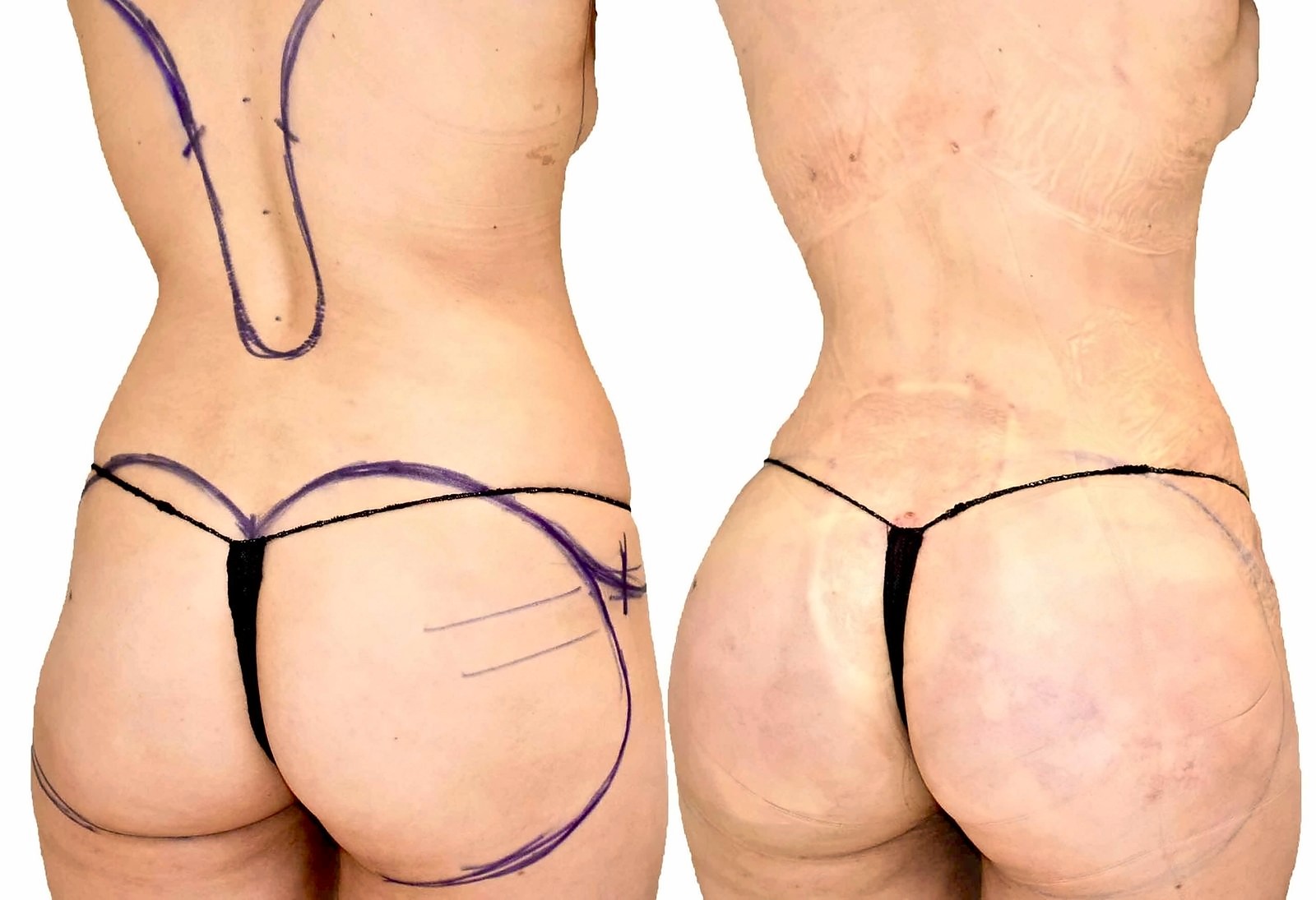 Before/After Fat Transfer, BBL before and after, actual patient of Dr. Long