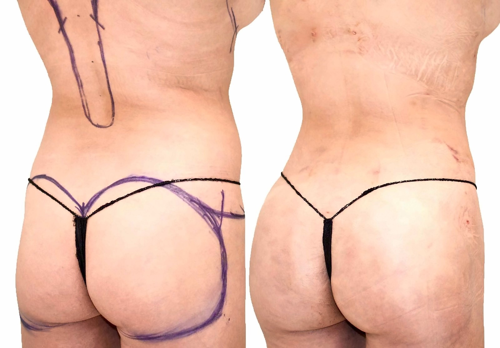 Before/After Fat Transfer, BBL before and after, actual patient of Dr. Long