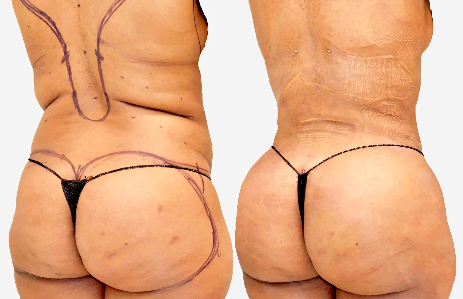 Before/After Fat Transfer, BBL before and after, actual patient of Dr. Long