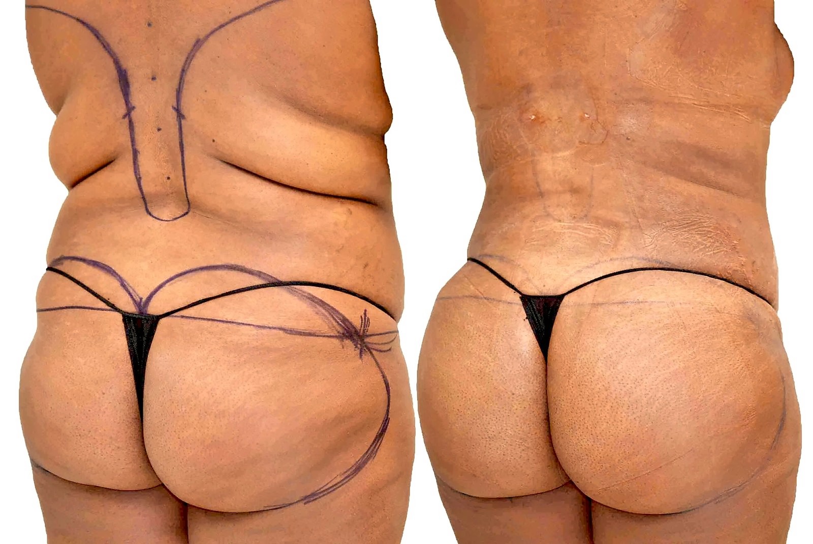 Before/After Fat Transfer, BBL before and after, actual patient of Dr. Long