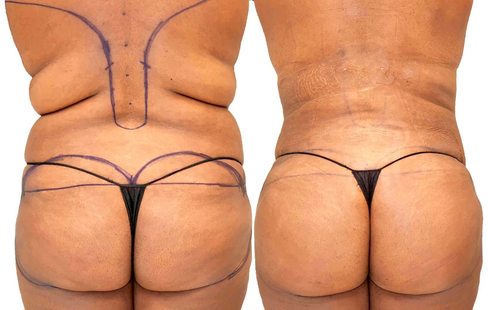 Before/After Fat Transfer, BBL before and after, actual patient of Dr. Long