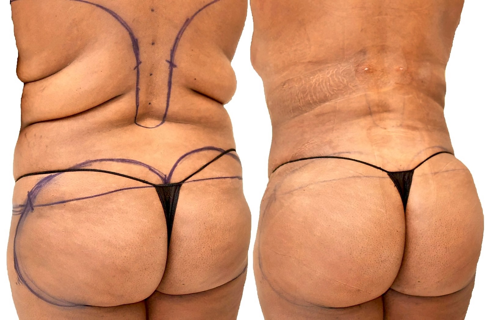 Before/After Fat Transfer, BBL before and after, actual patient of Dr. Long