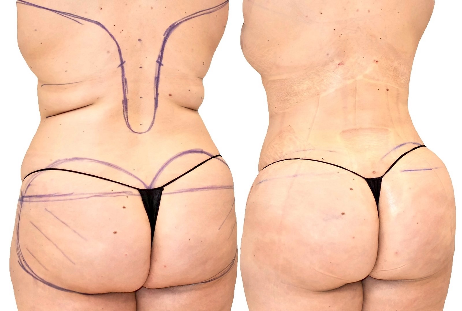 Before/After Fat Transfer, BBL before and after, actual patient of Dr. Long