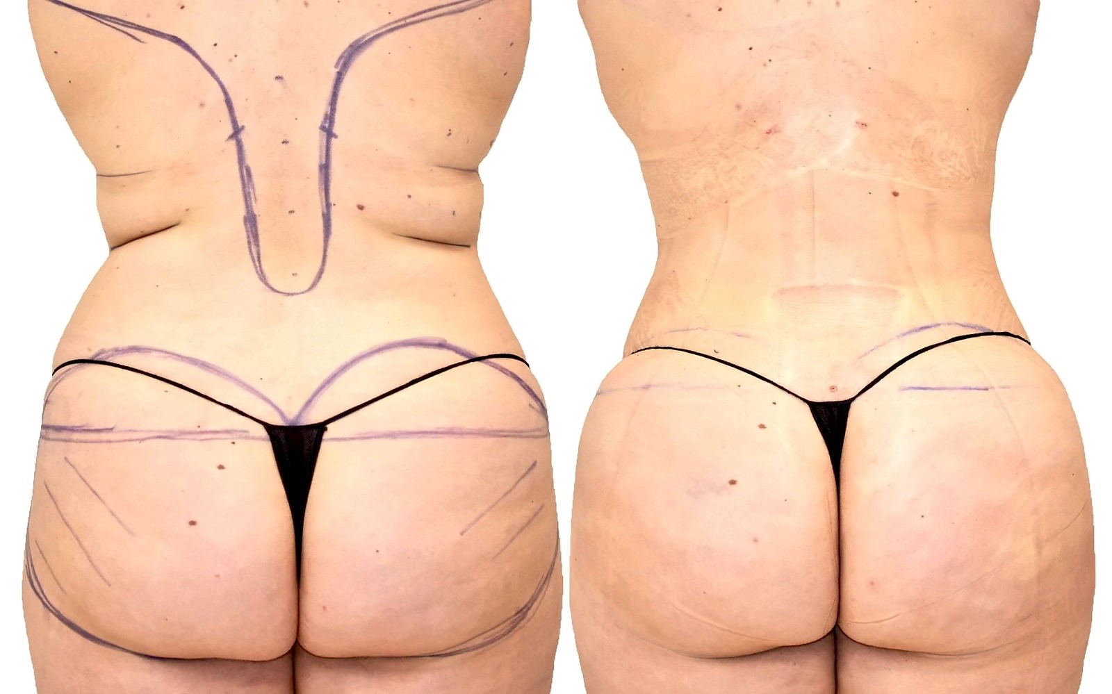 Before/After Fat Transfer, BBL before and after, actual patient of Dr. Long