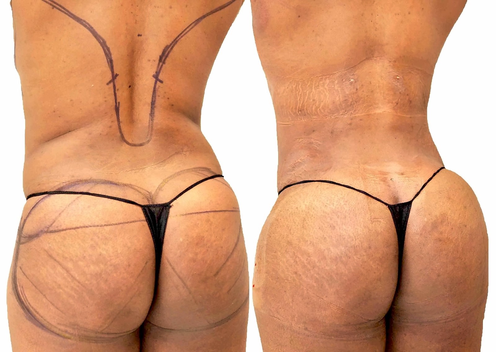 Before/After Fat Transfer, BBL before and after, actual patient of Dr. Long