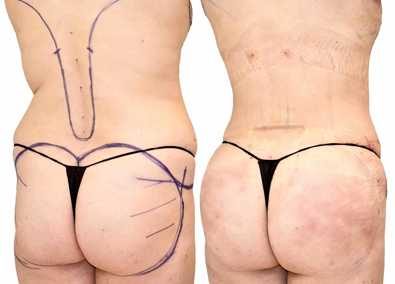 Before/After Fat Transfer, BBL before and after, actual patient of Dr. Long