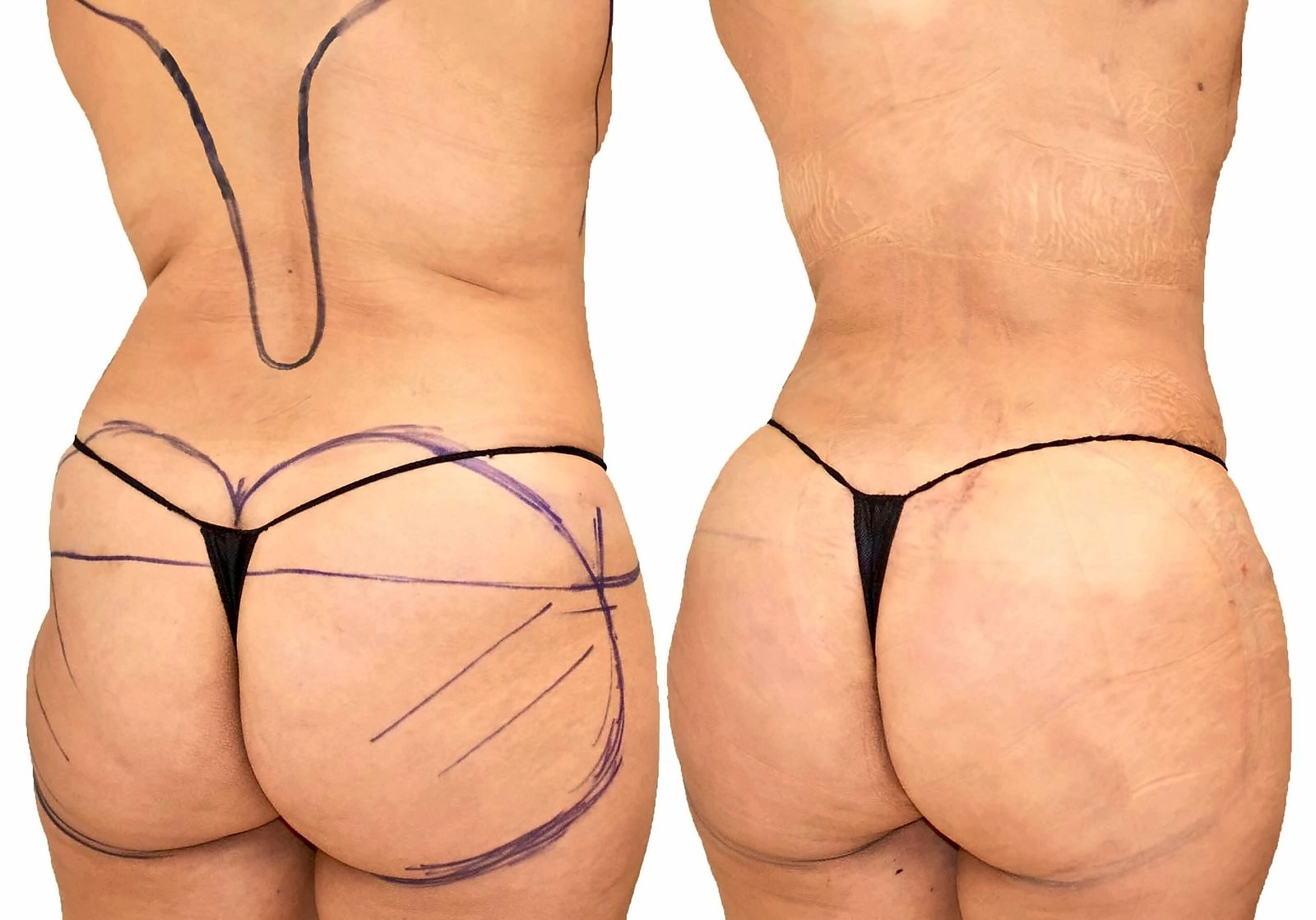 Before/After Fat Transfer, BBL before and after, actual patient of Dr. Long