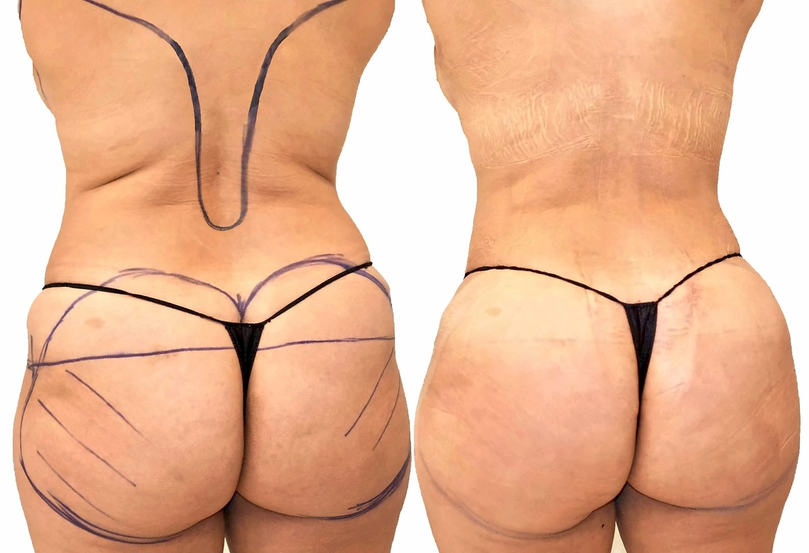 Before/After Fat Transfer, BBL before and after, actual patient of Dr. Long