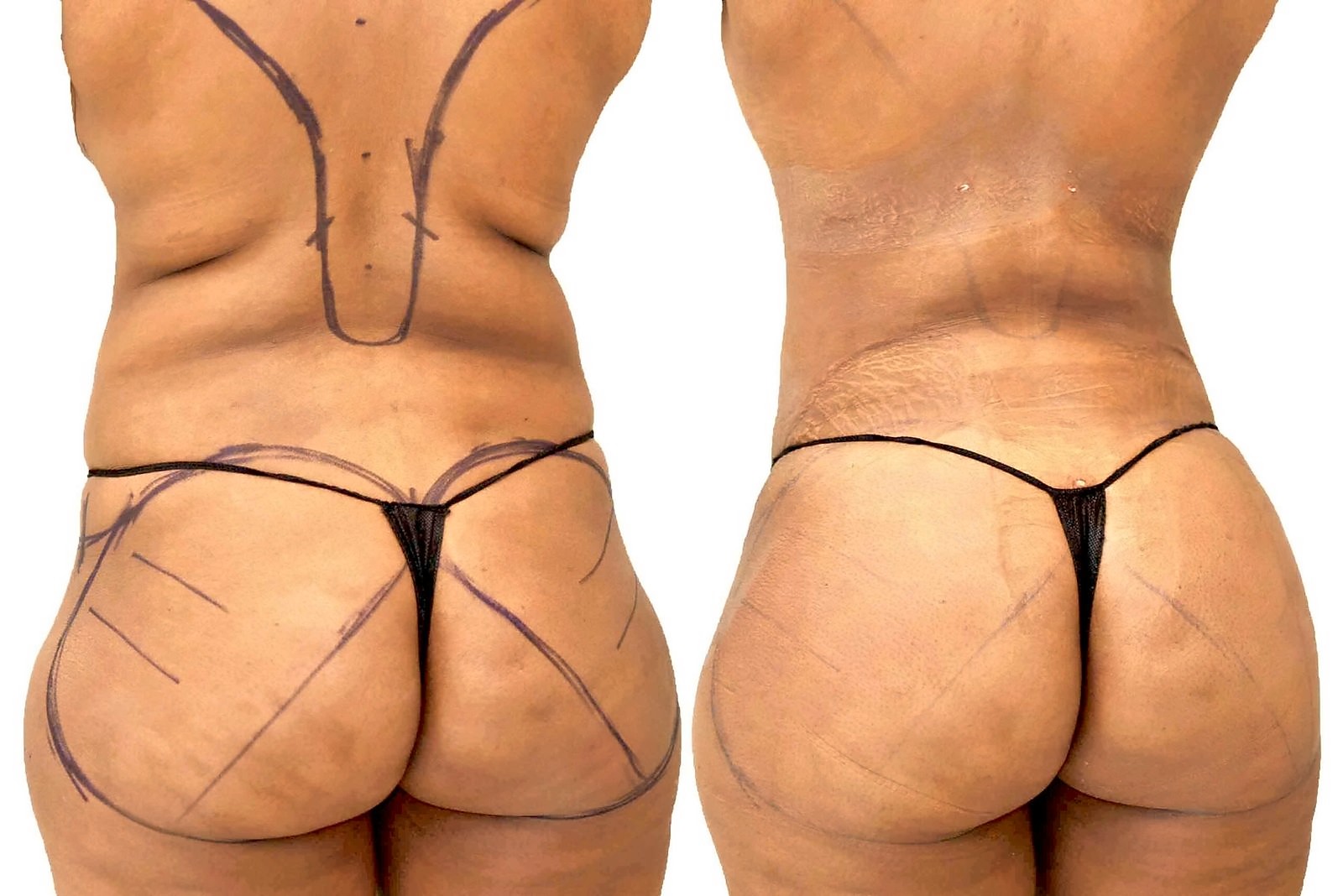 Before/After Fat Transfer, BBL before and after, actual patient of Dr. Long
