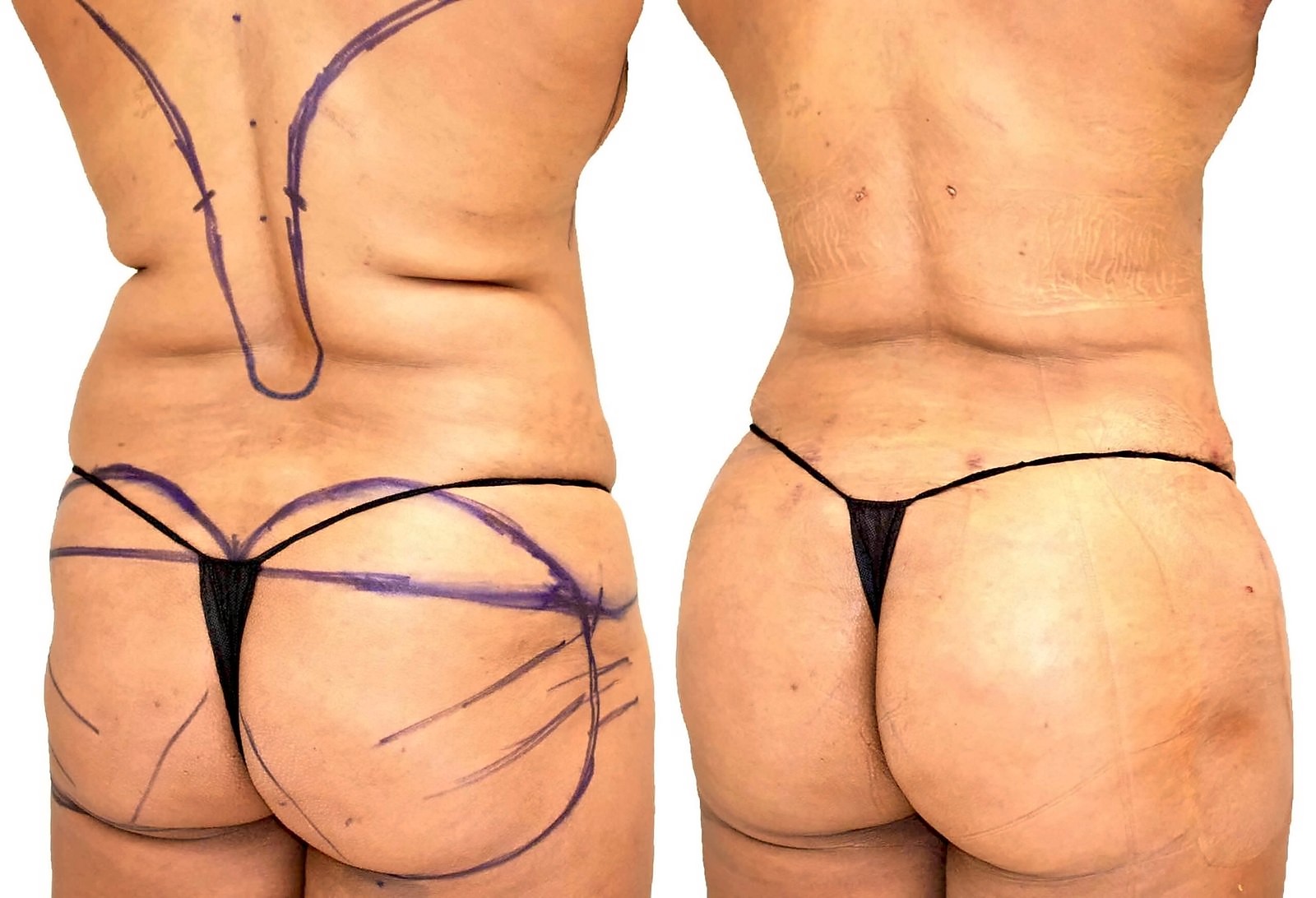 Before/After Fat Transfer, BBL before and after, actual patient of Dr. Long