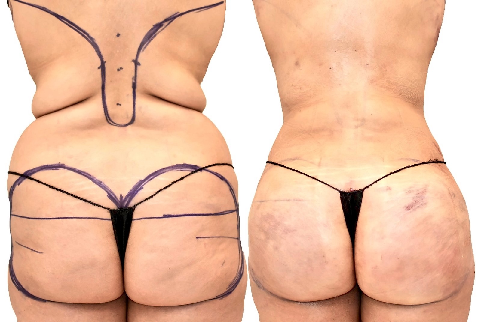 Before/After Fat Transfer, BBL before and after, actual patient of Dr. Long