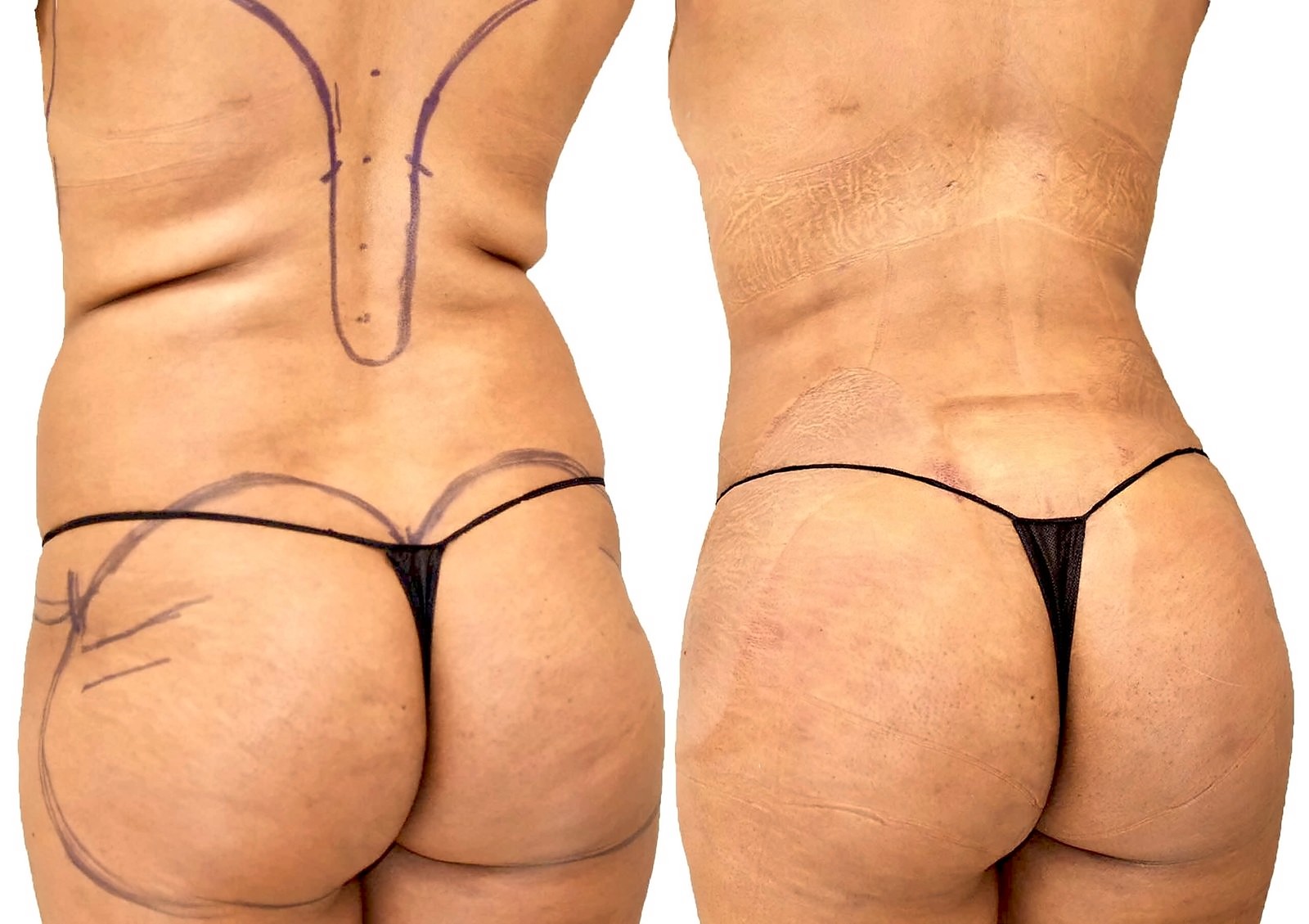 Before/After Fat Transfer, BBL before and after, actual patient of Dr. Long