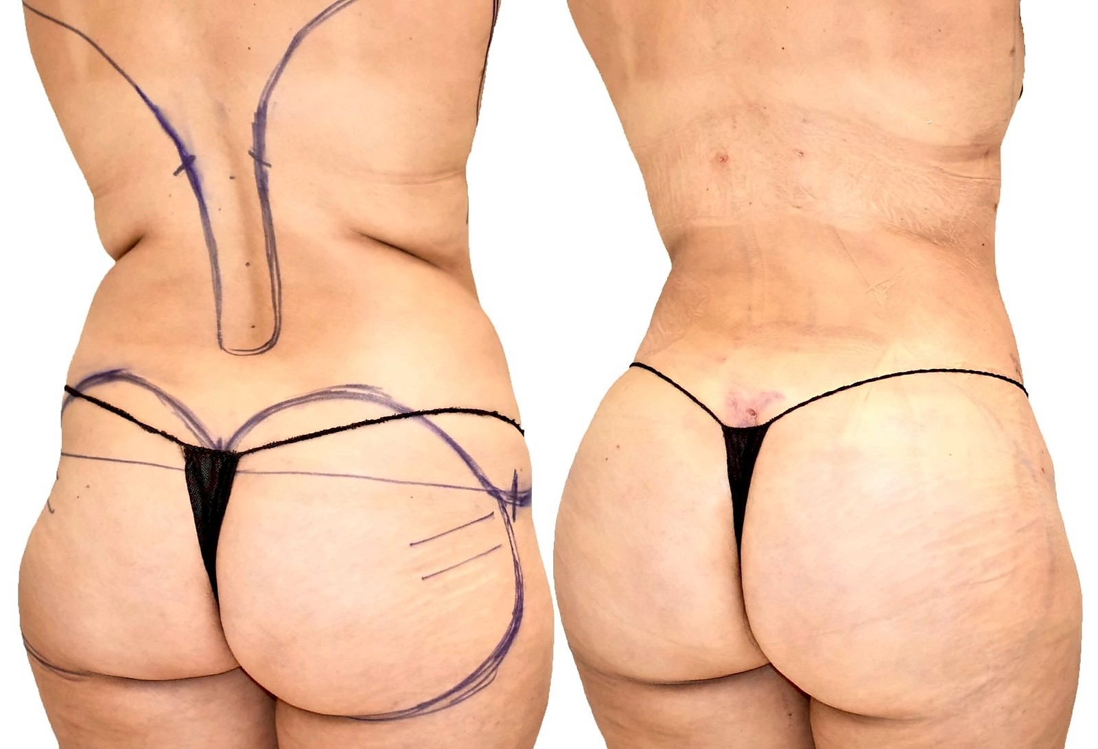 Before/After Fat Transfer, BBL before and after, actual patient of Dr. Long