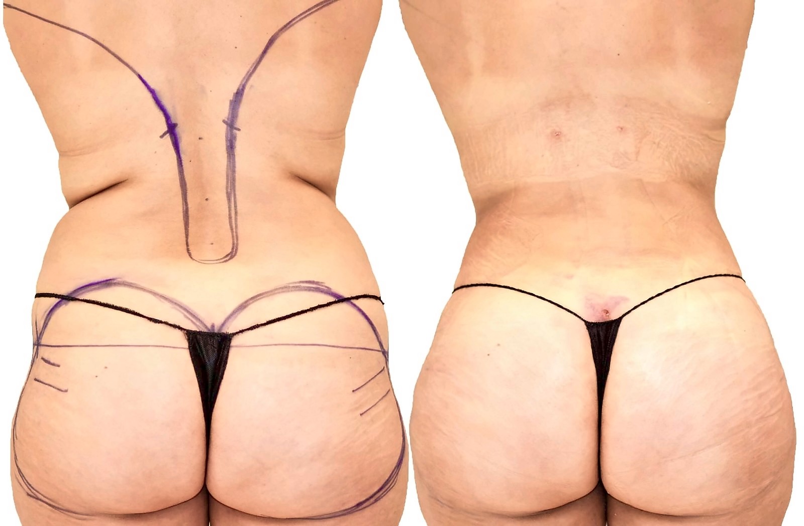 Before/After Fat Transfer, BBL before and after, actual patient of Dr. Long