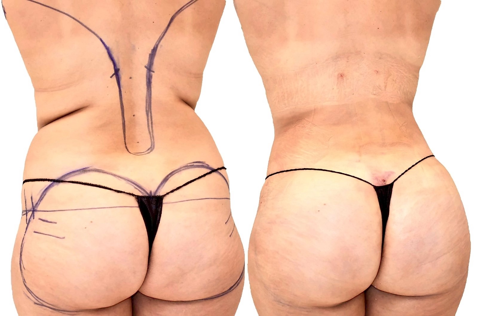 Before/After Fat Transfer, BBL before and after, actual patient of Dr. Long
