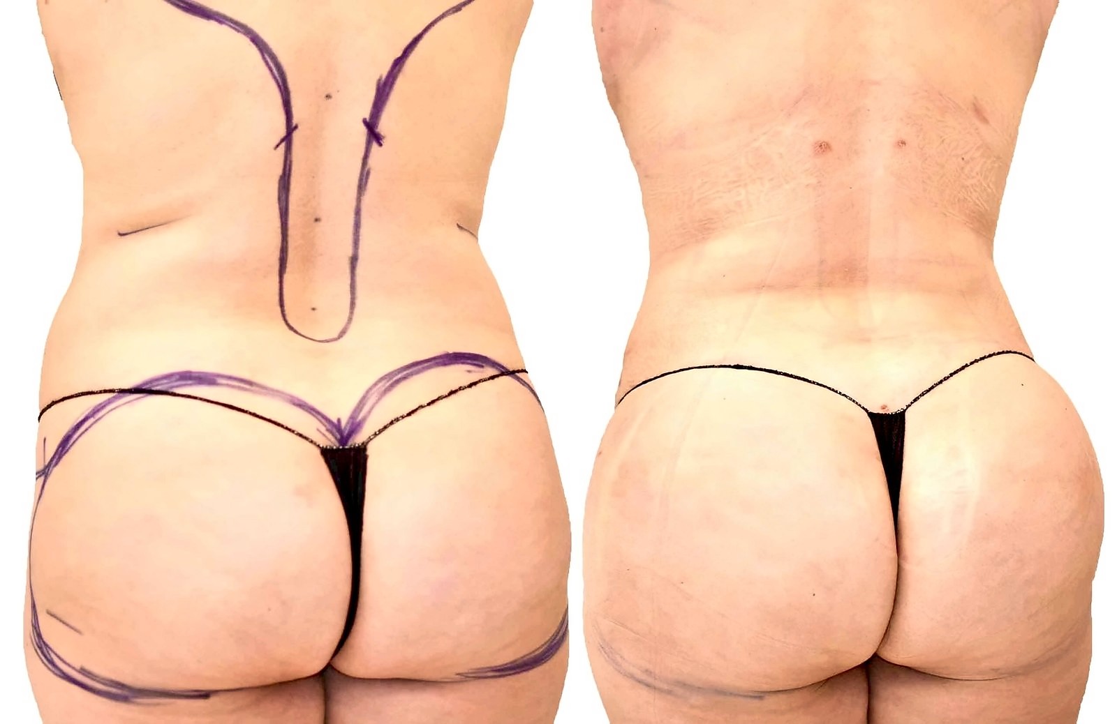 Before/After Fat Transfer, BBL before and after, actual patient of Dr. Long