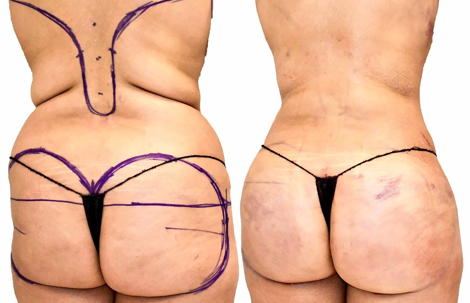 Before/After Fat Transfer, BBL before and after, actual patient of Dr. Long