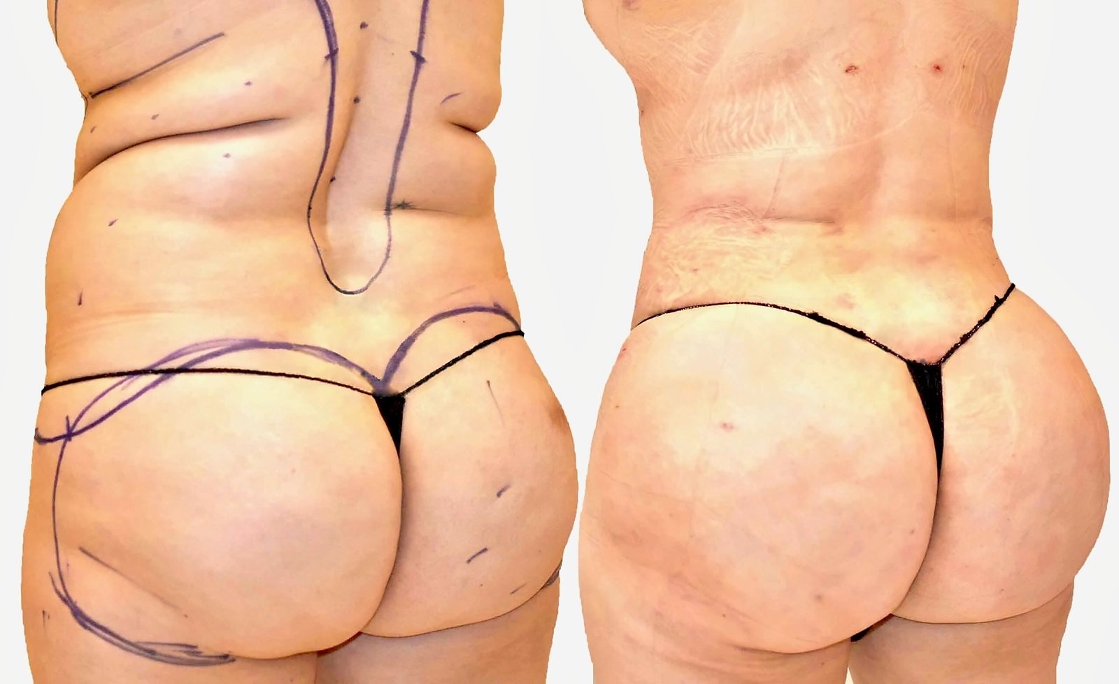 Before/After Fat Transfer, BBL before and after, actual patient of Dr. Long