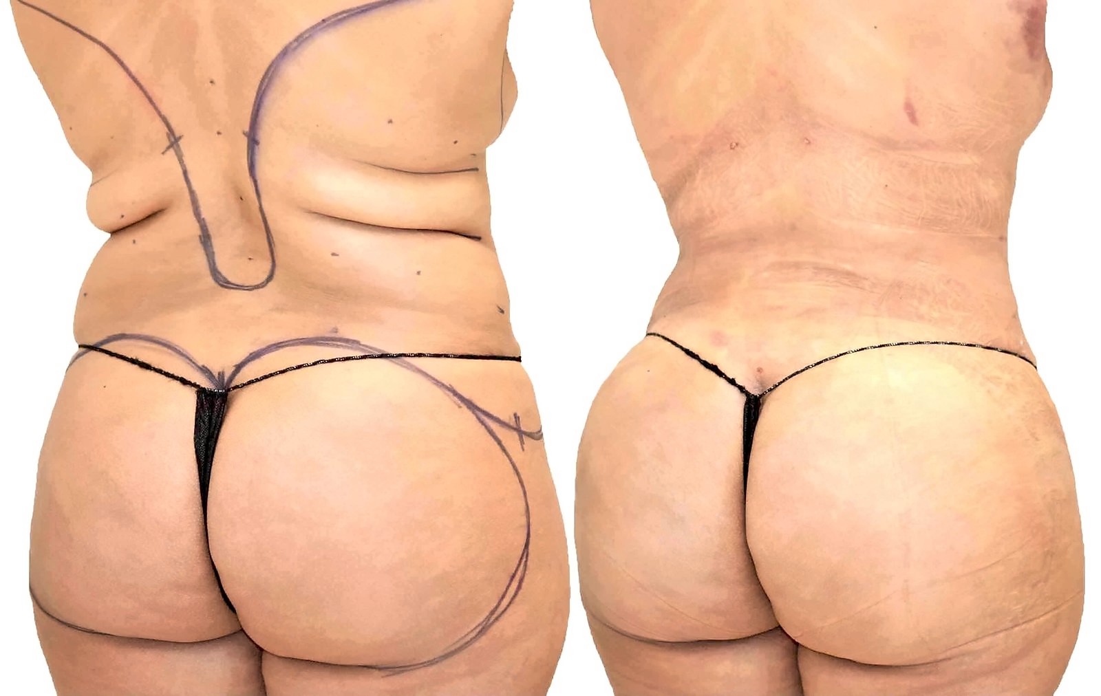Before/After Fat Transfer, BBL before and after, actual patient of Dr. Long