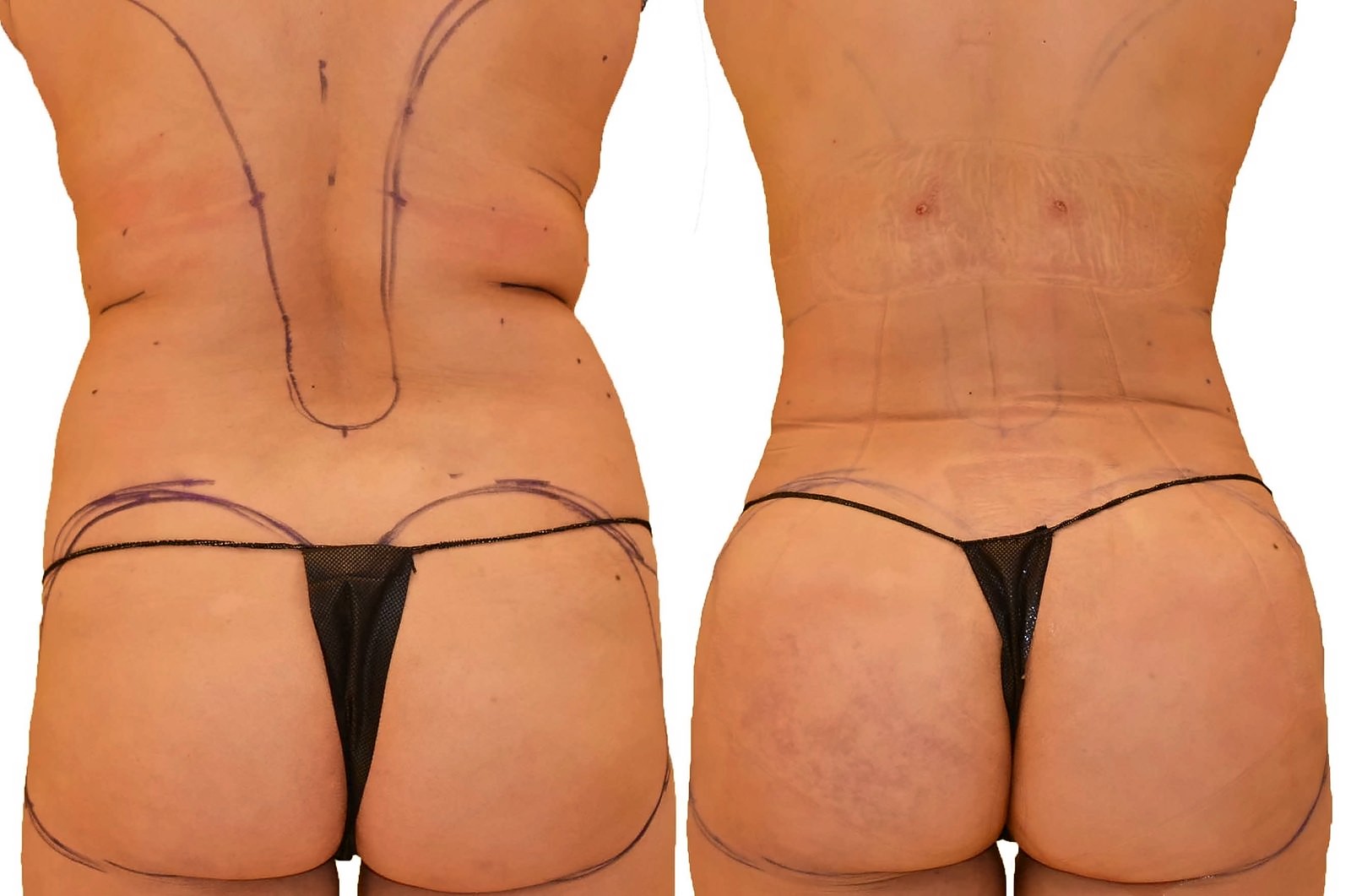 Before/After Fat Transfer, BBL before and after, actual patient of Dr. Long