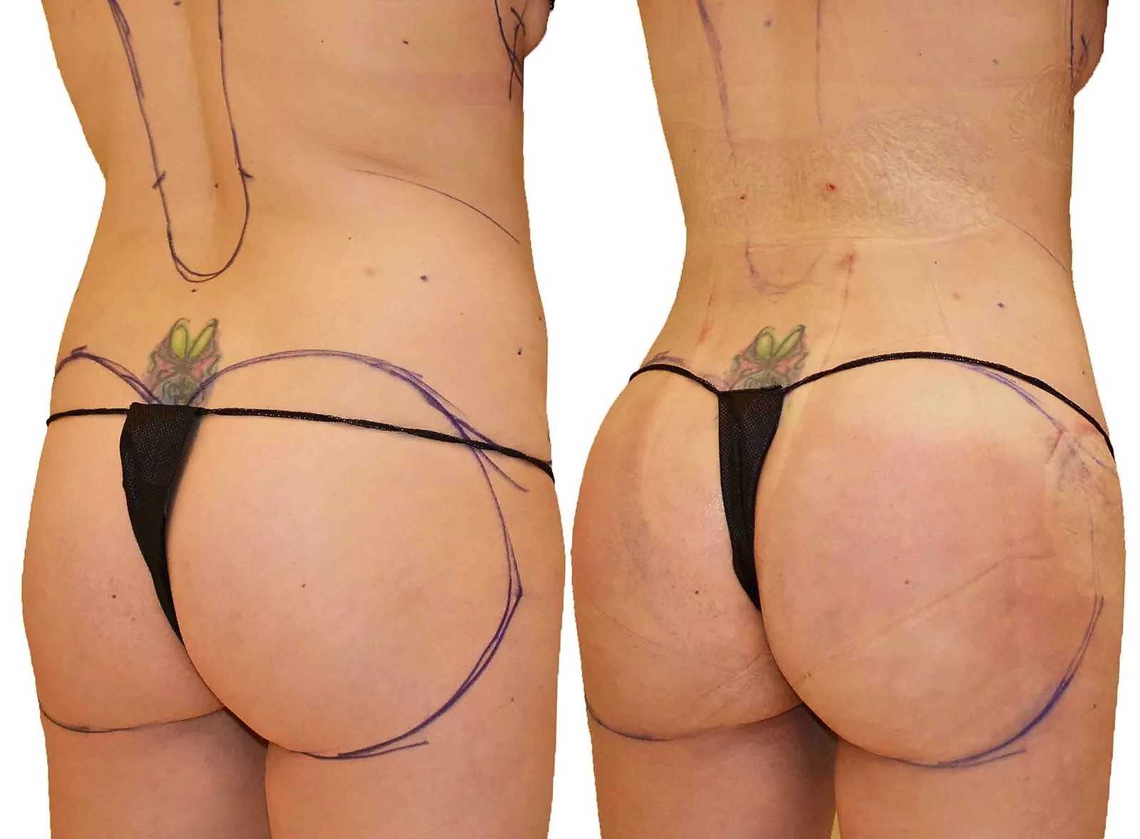 Before/After Fat Transfer, BBL before and after, actual patient of Dr. Long