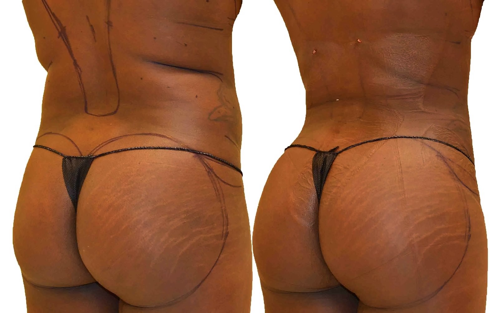 Before/After Fat Transfer, BBL before and after, actual patient of Dr. Long