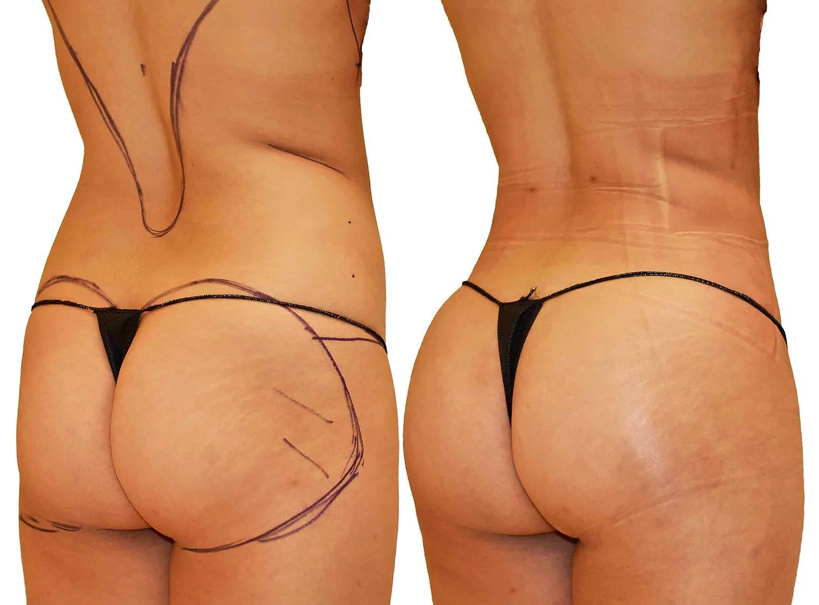 Before/After Fat Transfer, BBL before and after, actual patient of Dr. Long