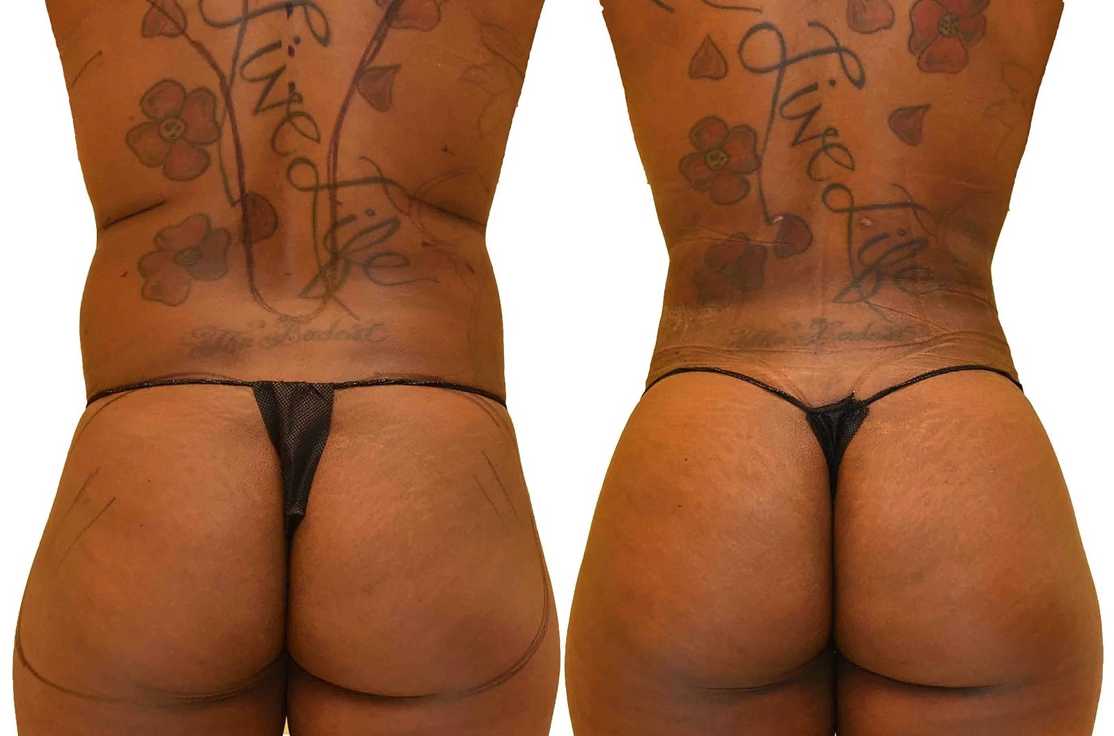 Before/After Fat Transfer, BBL before and after, actual patient of Dr. Long